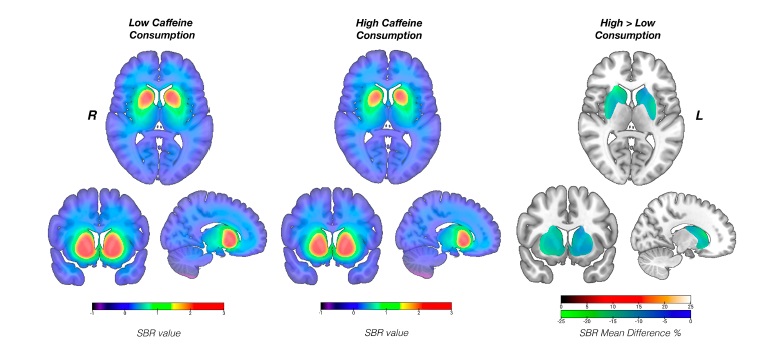 Brain imaging images with colours mapping the activity